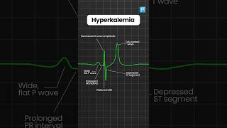 Hyperkalemia and Hypokalemia ECG changes [upl. by Tav355]