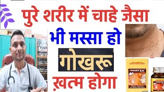 Warts  illa  Corn  Gorkhu gorkhul  Homeopathic medicine for warts corn  गोखरू  तिल और मस्से [upl. by Yasdnyl]