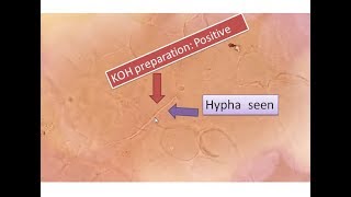 KOH positive  Fungal elements seen  Sputum  hyphae [upl. by Tindall]