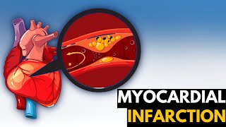 Myocardial Infarction Causes Signs and Symptoms Diagnosis and Treatment [upl. by Llecrad]