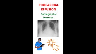 ✅ How To Diagnose Pericardial Effusion shorts xray [upl. by Garlan]