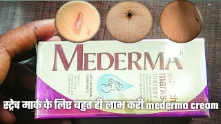 Mederma Stretch Marks Therapy Review in Hindi MEDERMA STRETCH MARK THERAPY स्ट्रेच मार्क्स का ईलाज [upl. by Stutman]