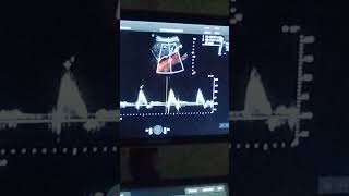 PRACTICA DE ECO DOPPLER AORTA [upl. by Emlyn]