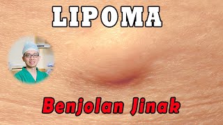 LIPOMA Tumor Jinak  Benjolan Lunak [upl. by Frantz]