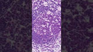 Toxoplasma Lymphadenitis Histology [upl. by Moersch]