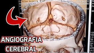 RECONSTRUCCIÓN 3D ANGIOGRAFIA CEREBRAL ☢😵 [upl. by Tim924]