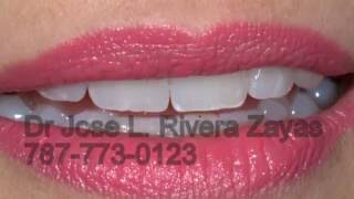 Estetica DentalProstodoncistaImplantes Dentales en Puerto Rico7877730123 [upl. by Lamarre]