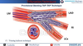 Trifurcation PS TAP TAP cardiology cardiologyfellow unam angioplasty imss nutrition [upl. by Aisekal]