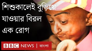 শিশুকালেই বুড়িয়ে যাওয়ার রোগ প্রোজেরিয়া কেন হয় [upl. by Sacci240]