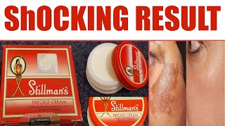 Stillmans Freckle Cream Review Benefits Price Side effects  Pigmnetation Removal Cream [upl. by Talia]