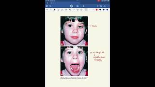 Ptosis l types l approach l Treatment [upl. by Bonita]