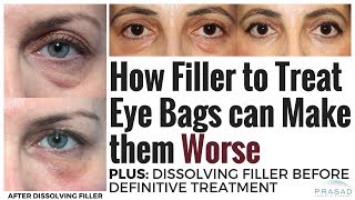 How Under Eye Fillers can Make Prominent Eye Bags Worse and Safely Dissolving Filler [upl. by Nahgen]