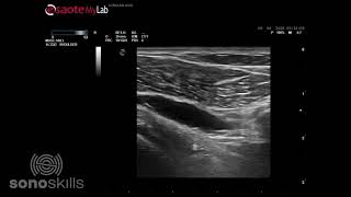 Subcoracoid bursitis during active external internal rotation [upl. by Dranal]