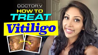 Vitiligo treatment by Targeted Phototherapy  Phototherapy amp Excimer Laser For Vitiligo  DrKailash [upl. by Eniretak]