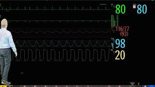 Philips IntelliVue Patient Monitoring  1  Introduction to Basic Operation [upl. by Kcirederf]