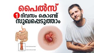 പൈൽസ് ഒരു ദിവസം കൊണ്ട് സുഖപ്പെടുത്താം  Piles Malayalam Health Tips [upl. by Locklin]