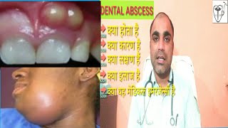 दॉतों में पस से कैसे पायें छुटकारा  Dental Abscess treatment  Dental Abscess types  Dental Absces [upl. by Uriah]