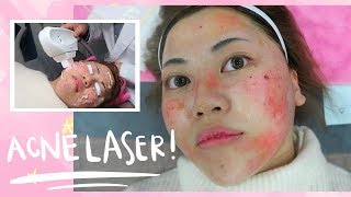 Painful ACNE LASER Experience in Korea [upl. by Lorollas727]