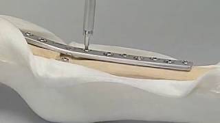 Arthrodesis of the MP Joint [upl. by Tupler]