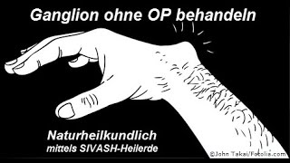 Überbein Ganglion ohne OP behandeln [upl. by Wassyngton]