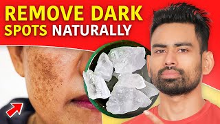 Acne Dark Spots  हिंदी  How to treat  serum cream recommendations  Dermatologist  Dr Aanchal [upl. by Ellmyer]