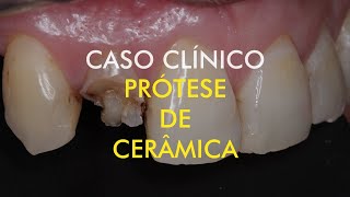 Prótese Unitária Dente Anterior Cerâmica • Dr Luis Drummond • Odontologia • Clínica Drummond [upl. by Valonia]