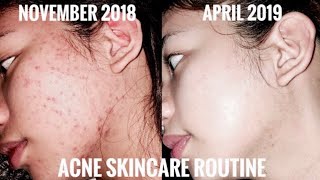 How I Cleared my Acne amp Pimples in 1 Month using Kojie San Soap amp Eskinol  DalacinC 🙈🤍🧖🏻‍♀️ [upl. by Haisej]