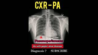 Pneumoperitoneum  Peptic ulcer disease  Diagnosis   Short [upl. by Arramas]