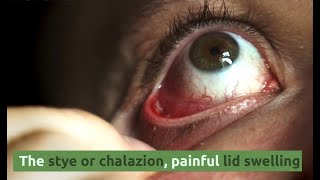 Hordeolum Externum STYE vs Hordeolum Internum  Comparing with Chalazion  Eyelid Lectures [upl. by Nerdna]