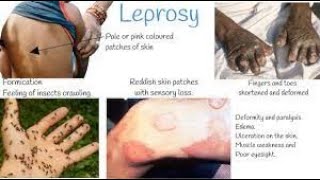 Leprosy  leprosy treatment  Leprosy pathology  hensens disease  leprosy disease [upl. by Nylrak803]