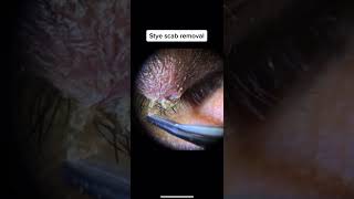 Stye Scab Removal [upl. by Anaz]