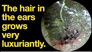 The hair in the ears grows very luxuriantlyear wax removal  ear cleaning  ASMR  relaxation [upl. by Constantin764]