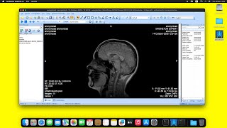 MicroDicom DICOM Viewer on macOS Sequoia using Wine [upl. by Nnair750]