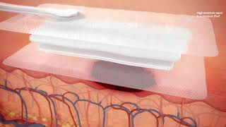 How PICO sNPWT works on open wounds [upl. by Ela]