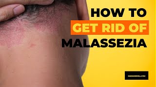 How To Get Rid Of Malassezia [upl. by Tyson]