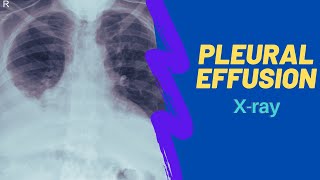 Imaging of pleural effusion For medical students clinicans and residents [upl. by Elleniad]