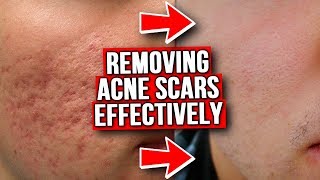 GET RID OF ACNE SCARS FROM EXPERIENCE [upl. by Jard]