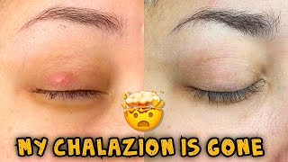 Update My Chalazion is Gone  How did I get rid of it [upl. by Goodrow308]