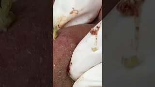 Big Cystic Acne Blackheads Extraction Blackheads amp Milia Whiteheads Removal Pimple Popping [upl. by Jaenicke]