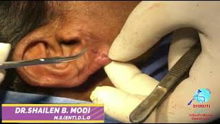 EAR LOBULE REPAIR WITH CHEMICAL [upl. by Valli]