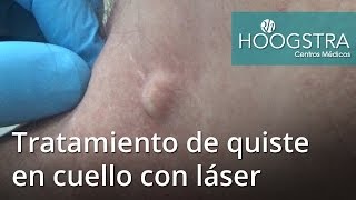 Tratamiento de quiste en cuello con láser 16126 [upl. by Oahc]