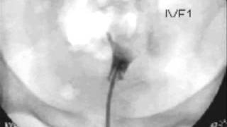 Hysterosalpingogram  HSG [upl. by Leahciam385]