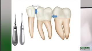 How to make molar extractions easier [upl. by Atirrehs]