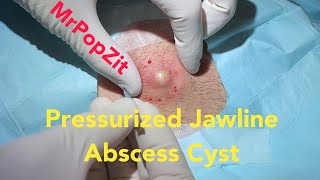 Pressurized Jawline Abscess Cyst Squirting cyst pop with surprising large sac dissection on neck [upl. by Larsen604]