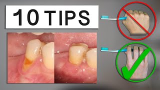 10 Tips to Minimize Gum Recession at Home [upl. by Galanti]