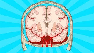 Stroke subarachnoid haemorrhage [upl. by Oigroeg]