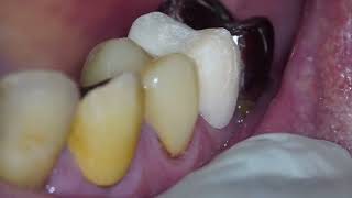 Create a temporary crown on the upper right premolar [upl. by Bobette]