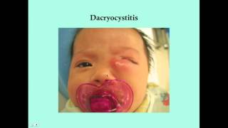 Dacryocystitis  CRASH Medical Review Series [upl. by Ula469]