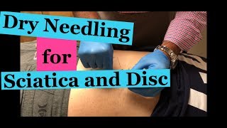 Chiropractic Treatment for Lumbar Disc Herniation and Sciatica  DRY NEEDLING and DECOMPRESSION [upl. by Ima]