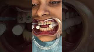 Align crooked and overcrowded teeth with Metal Braces shorts braces metalbraces [upl. by Toft903]